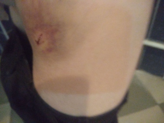 Станіслаў Цыбінскі пасля нападу. Фота: прадастаўлена героем Станіслаў Цыбінскі пасля нападу. Фота: прадастаўлена героем