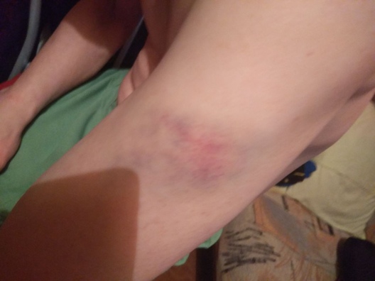 Станіслаў Цыбінскі пасля нападу. Фота: прадастаўлена героем Станіслаў Цыбінскі пасля нападу. Фота: прадастаўлена героем