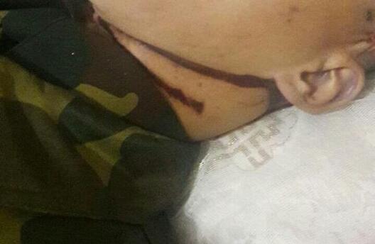 Дзве странгуляцыйныя баразны. Дзве странгуляцыйныя баразны.