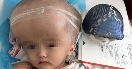 У Кітаі правялі першую ў свеце аперацыю па памяншэнні галавы (ФОТА)